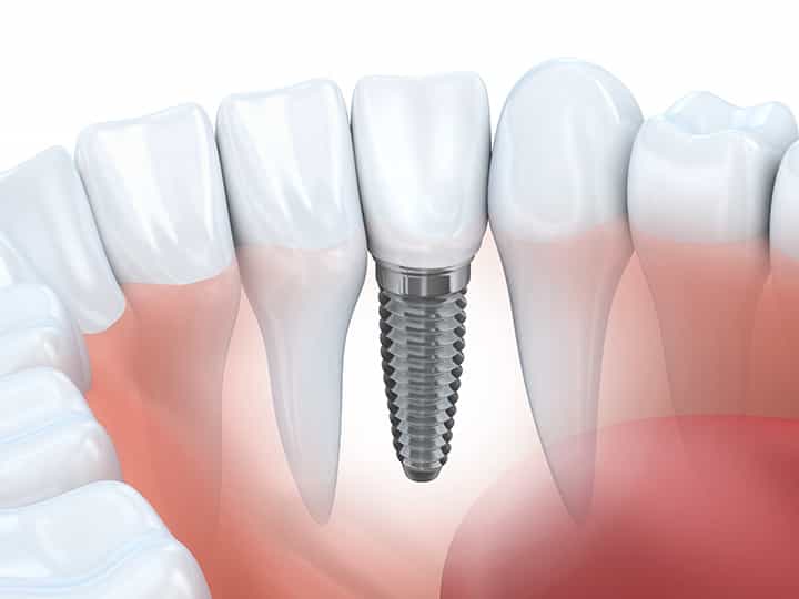 Dental Implants in Springfield VA