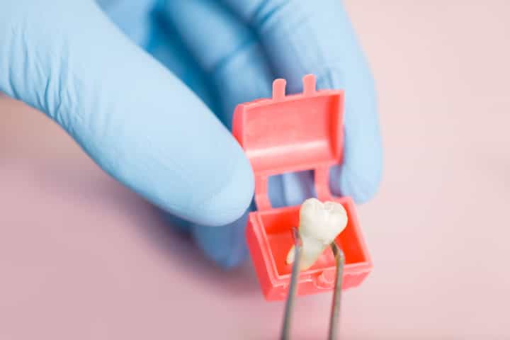 Tooth Extraction in Springfield, VA