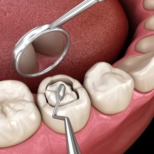 Decayed,Tooth,Restoration,With,Composite,Filling.,Dental,3d,Illustration